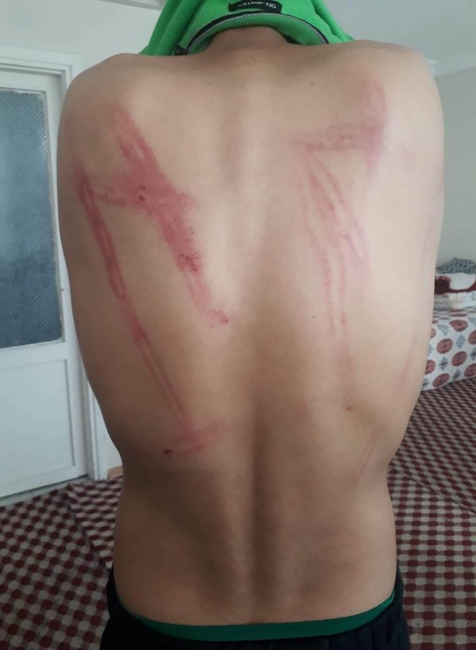 A 19-year-old man from Kapisa in Afghanistan shows injuries inflicted by people he believes were Greek police officers when he was pushed back from Diavata camp in Thessaloniki in April 2020. 