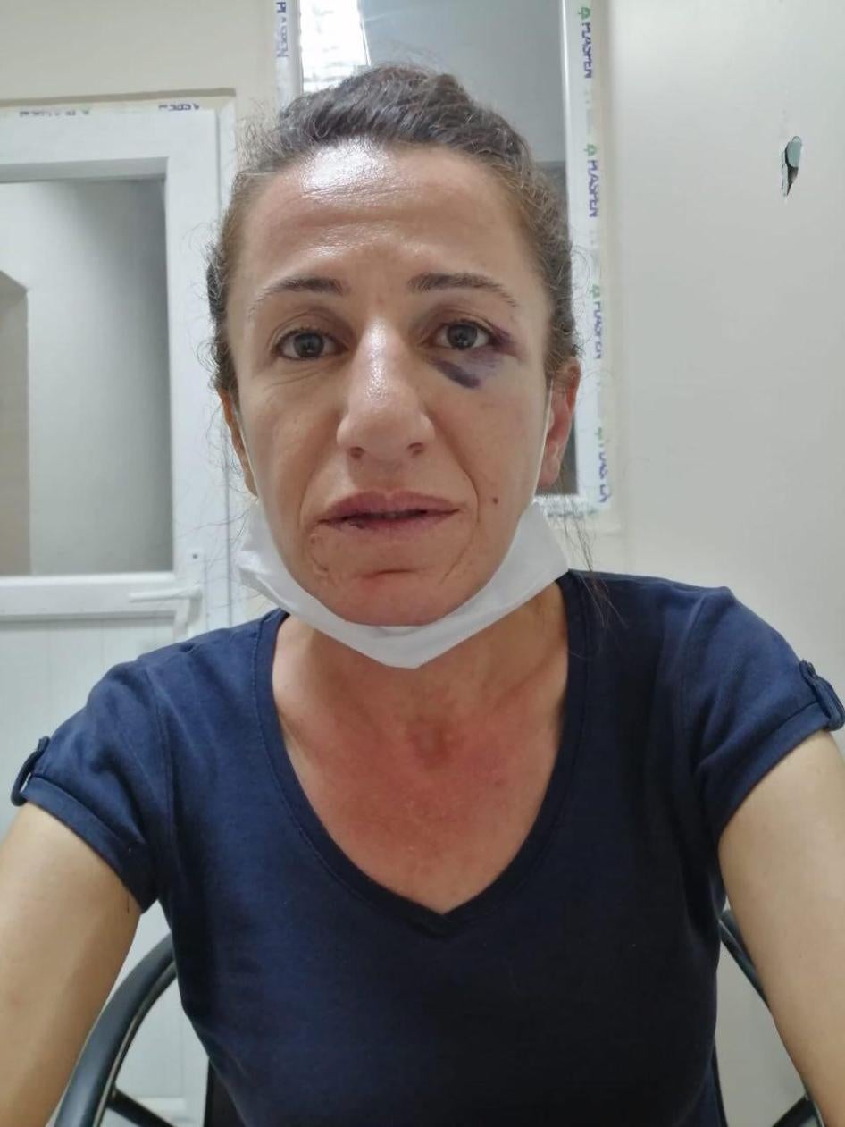 Sevil Çetin, yaşadığı dairede polis köpekleri tarafından saldırıya uğradığını ve ısırıldığını ve polis memurları tarafından dövüldüğünü iddia ediyor.