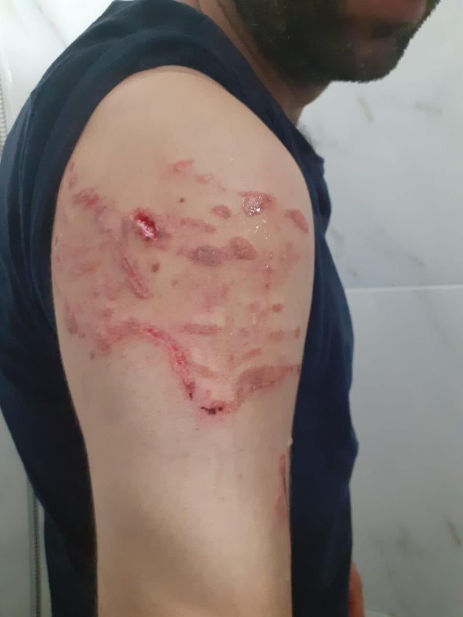 Seyhmus Yılmaz, polis köpekleri tarafından ısırıldığını ve tırmalandığını ve polis memurlarının onu dövdüğünü söylüyor.