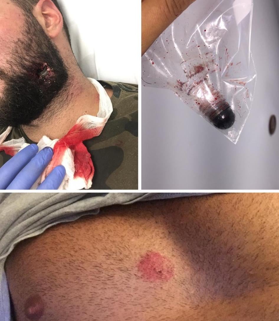 Security forces fired a rubber ball at Raby Zenno’s chest and at his face at close range, causing the casing and the ball to embed in his cheek.