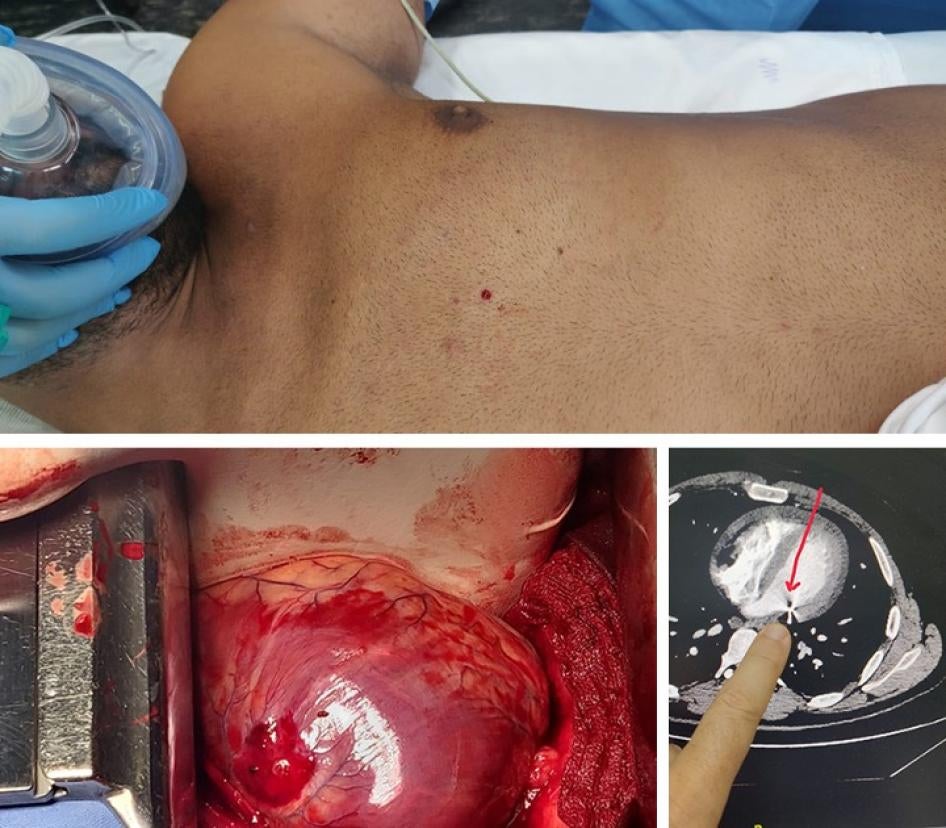 كرة خردق معدنية أصابت المحامي فراس حمدان وثقبت قلبه كما يظهر في الأشعة السينية.