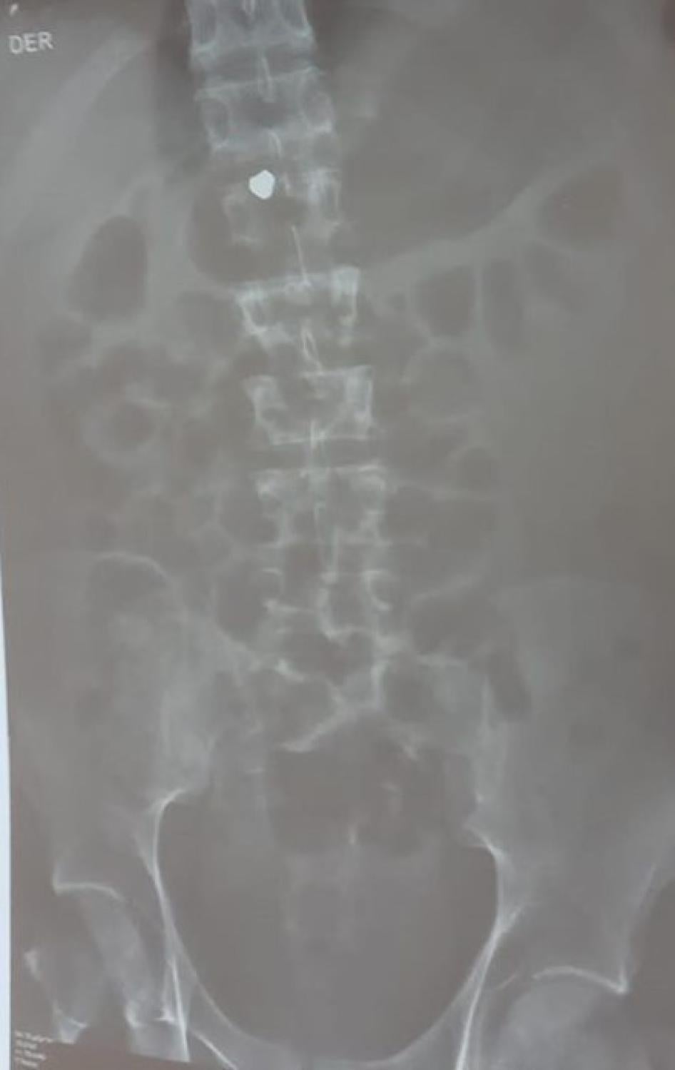 X-ray showing a pellet, believed to be lead, lodged in Jon Cordero’s spinal cord. Photograph courtesy of Jon Cordero’s family.