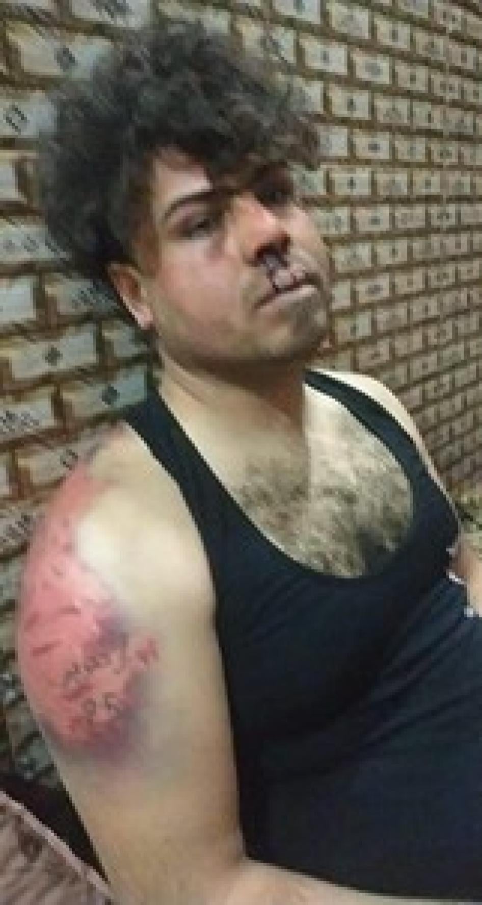 Ali Naseer Alawy, after armed masked men beat him and used an acid mixture to try to remove a tattoo on his arm.
