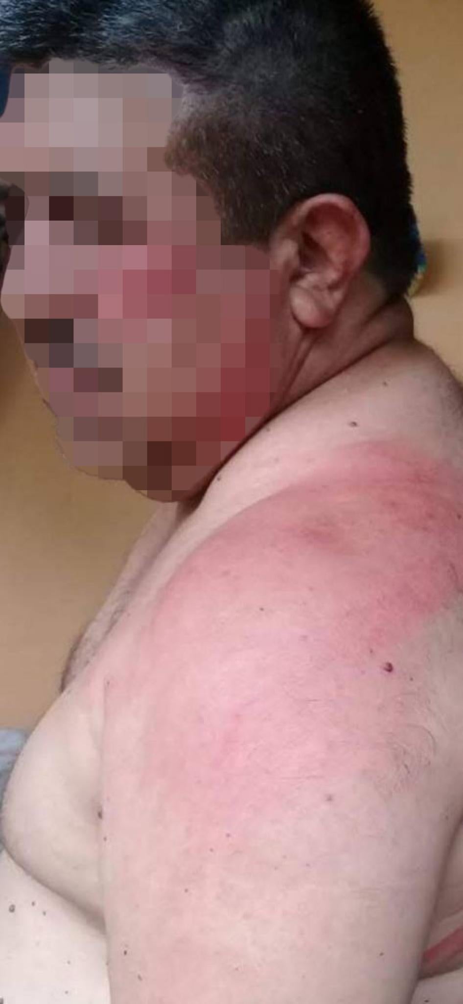 A pixelated photo of a man showing bruising on his body