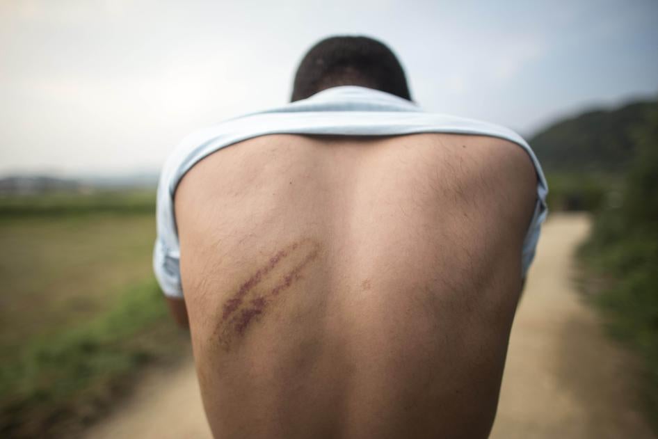 A refugee in Bosnia and Herzegovina shows injuries he says were the result of a beating by Croatian police August 2018.
