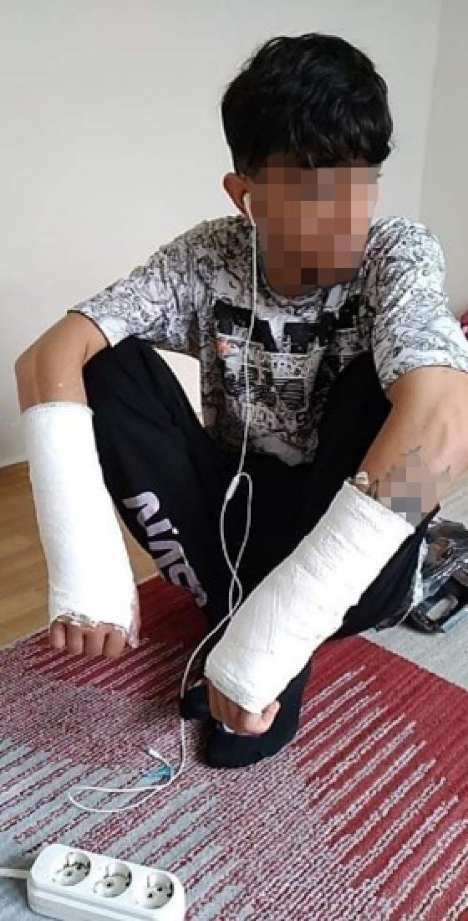 This 21-year-old Afghan man told Human Rights Watch he broke both wrists during an encounter with Bulgarian authorities on or around November 12, 2021 after crossing into Bulgaria from Turkey. His face has bruising, a black eye, and lacerations that cannot be shown to protect his identity. © 2021 private