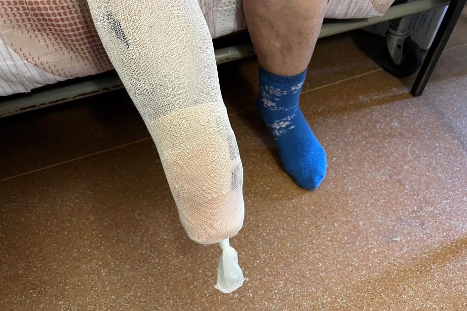 Un habitant de la région d’Izioum, en Ukraine, dont une jambe a dû être partiellement amputée après qu’il ait marché sur une mine antipersonnel PFM près de son domicile. 