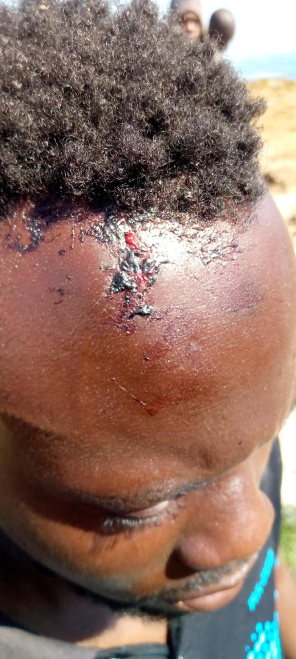 Un homme expulsé vers la frontière libyenne par les autorités tunisiennes montre sa blessure à la tête, le 5 juillet 2023. © 2023 Privé