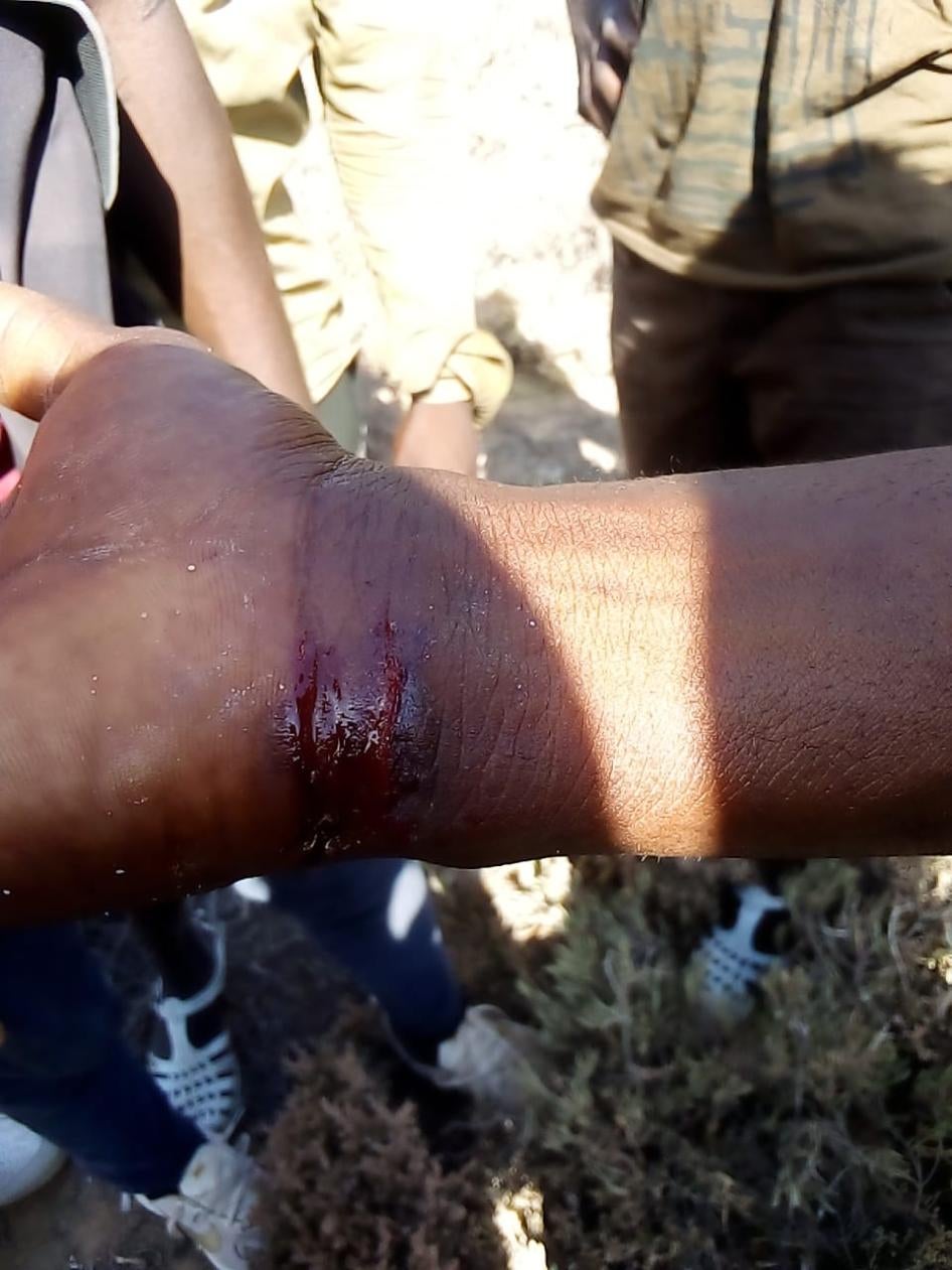 A man expelled to the Tunisia-Libya border by Tunisian authorities in early July shows his hand injury from a beating by Tunisian security forces, July 6, 2023.  © 2023 Private