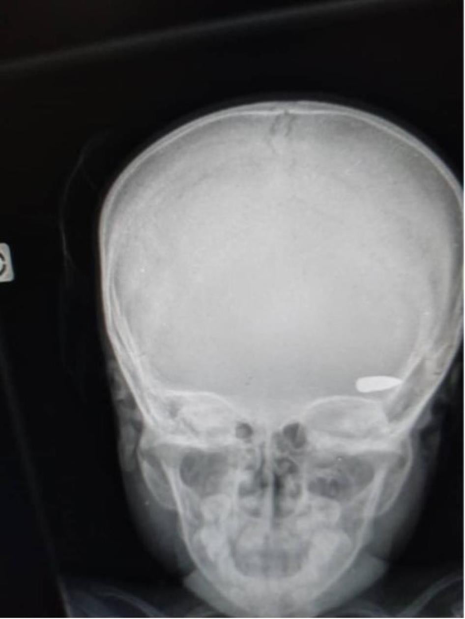 x-ray of a skull