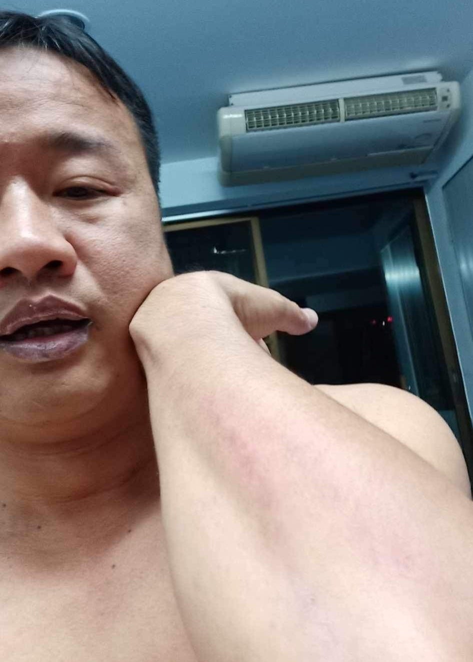 Opposition Cambodian activist Chamroeun Suon displays injuries he sustained after two assailants attacked him in Bangkok, Thailand on December 22, 2019.