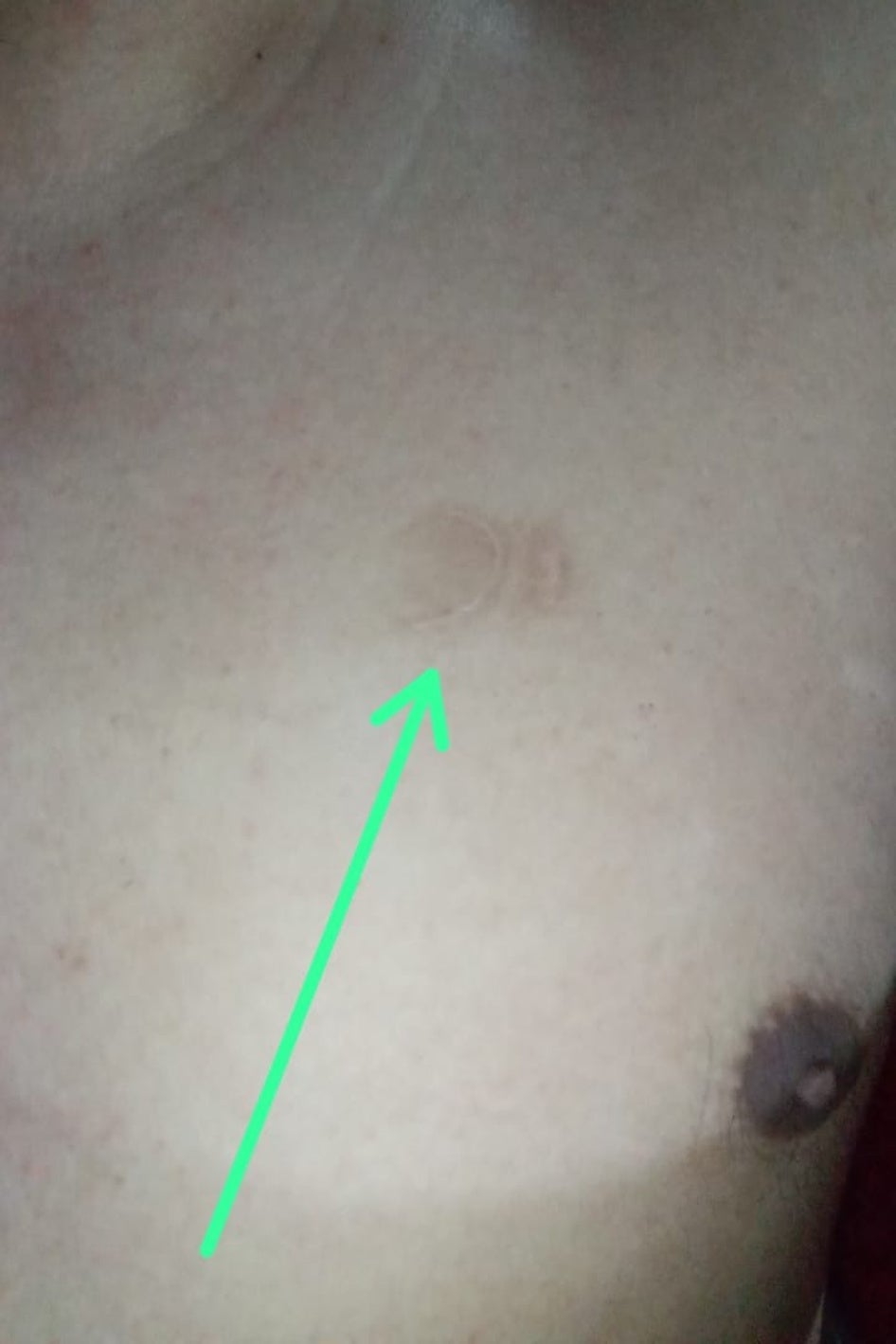 Photo of a wound on Carlos J.’s chest from a rubber pellet. 