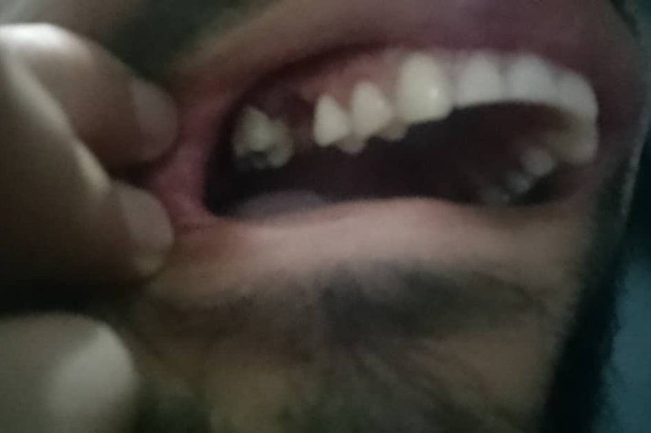 Photo of a gap left in Javier L.’s mouth after losing a tooth.