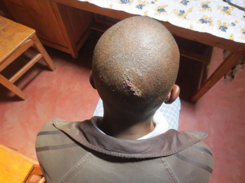 Imbonerakure (members of the ruling party youth league) beat this 23-year-old man unconscious on June 30, 2015, after he tried to intervene to help others who were being beaten. 