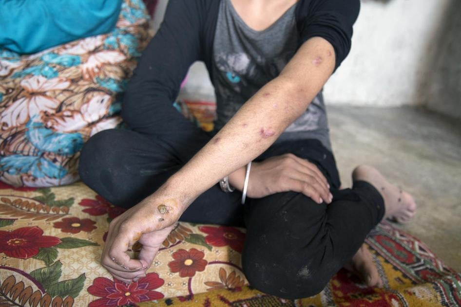 Muna, 10, shows injuries on her arm that she sustained when a mine exploded as she and her family tried to flee from ISIS-controlled territory in Manbij in early August. 