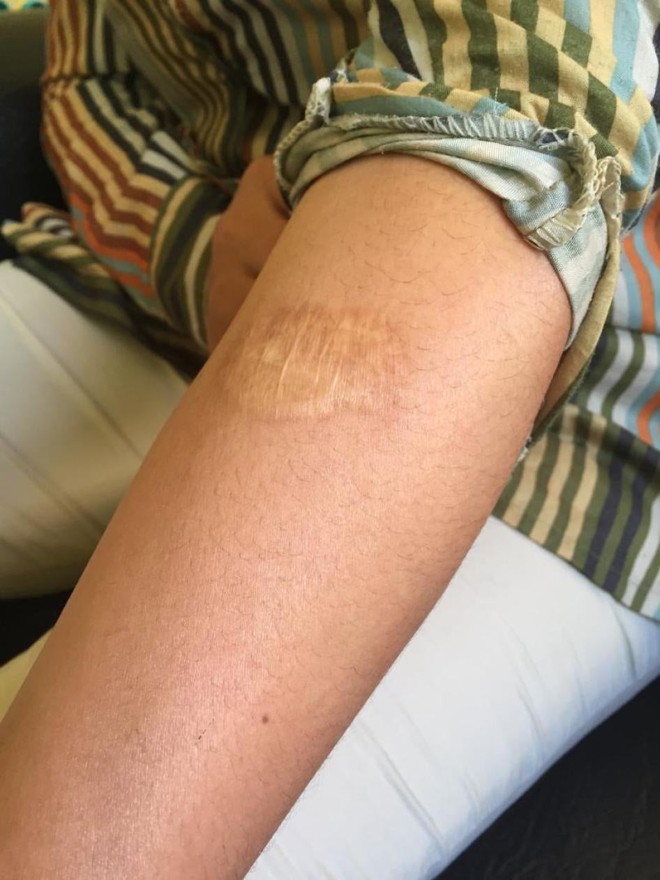 Moroccan domestic violence survivor "Fatima" shows her arm with a burn mark.