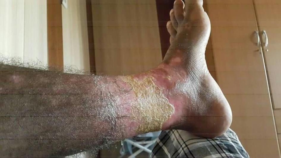 Photo taken on November 3 of blisters on the leg of a victim formed after exposure to the chemical substance contained in projectiles fired on the town of Qayyarah on September 21, 2016. 