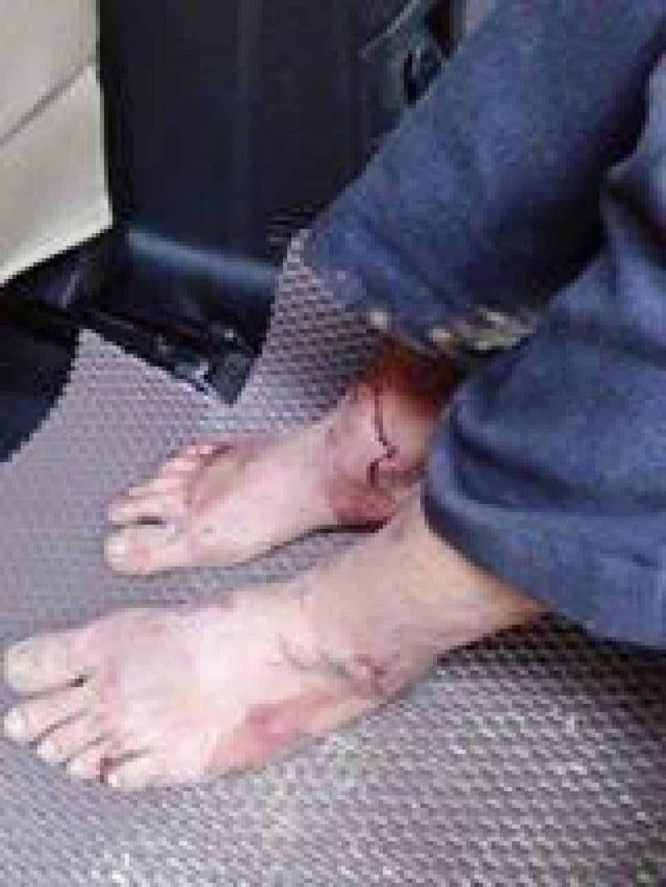 Nguyen Trung Ton and his feet after being assaulted in Quang Binh on February 27, 2017. 
