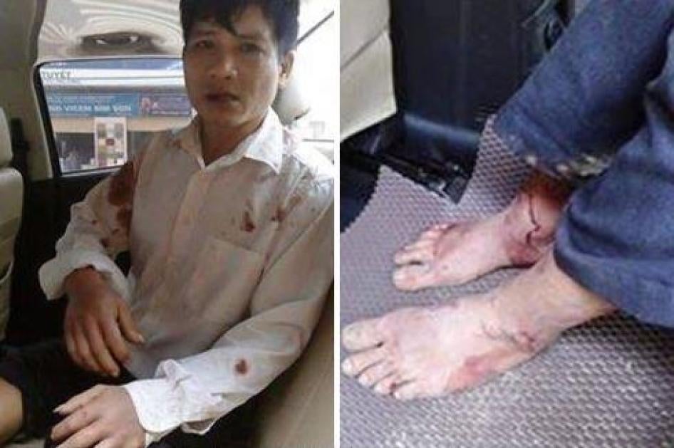 Nguyễn Trung Tôn với cái chân bị thương sau khi bị hành hung ở Quảng Bình ngày 27 tháng Hai năm 2017.