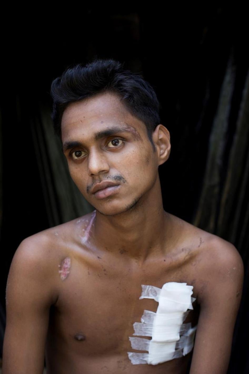 محمد الحسن، شاب من الروهينغا عمره 18 عاما، أصيب بعدة أعيرة نارية أطلقها جنود بورميون. 