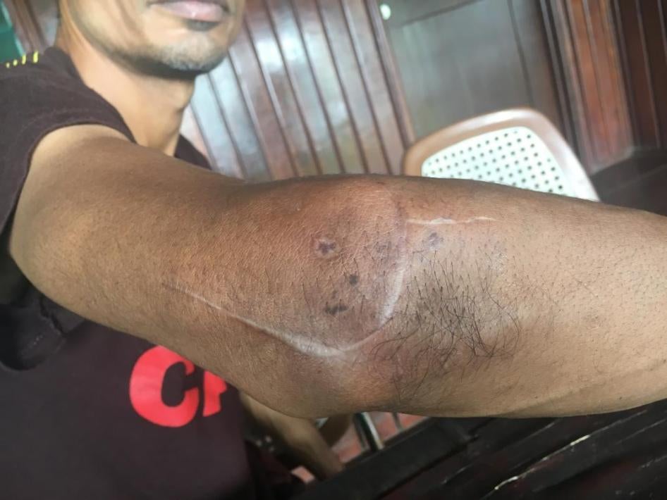 贾辛（化名），因澳大利亚离岸审查政策，被关在巴布亚新几内亚已逾四年。他的手肘被暴徒砍伤，手机也被抢走，2017年6月。