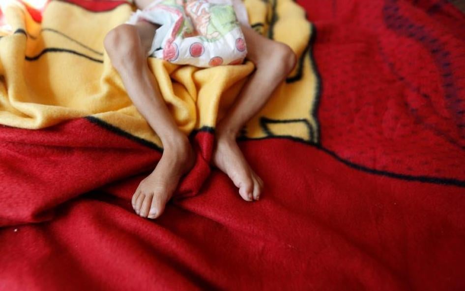 A malnourished boy lies on a bed at a malnutrition treatment center in Sanaa, Yemen, November 21, 2017. © 2017 Reuters