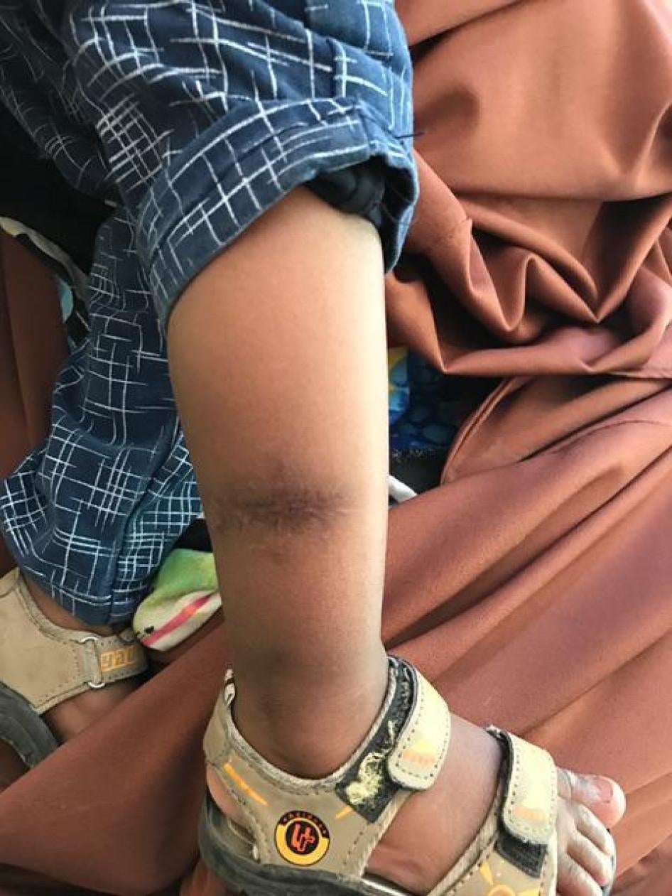 A toddler who at age 5 months was hit by a bullet in the leg during the Jamaac Dubad killings.  His mother and grandmother were killed in the incident, December 2016. 