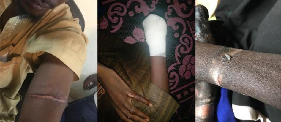 D'anciens détenus montrent leurs cicatrices ainsi qu’un bandage suite à l’amputation d’une main, après avoir été longtemps ligotés avec des cordes, des cordons en plastique ou leur propre turban par les forces de sécurité maliennes, lors d'opérations anti