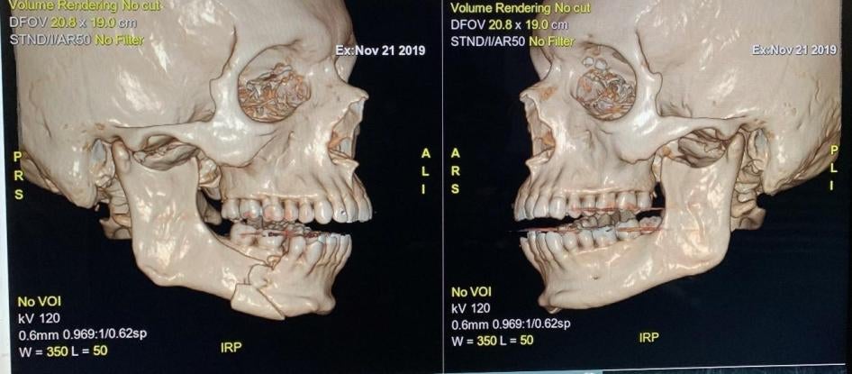 Image of Inda’s broken right jaw taken at the Carlos Van Buren Hospital in Valparaíso. November 21, 2019. 