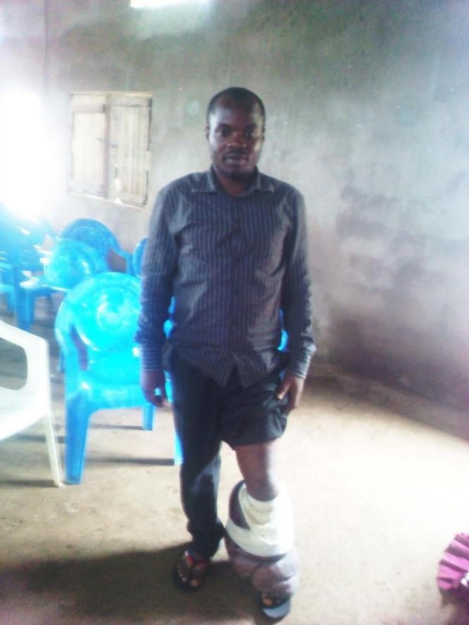 Denis, a 30-year-old man from Lysoka village, South-West region, with lymphatic filariasis, a parasitic infection leading to severe swelling and permanent disability.