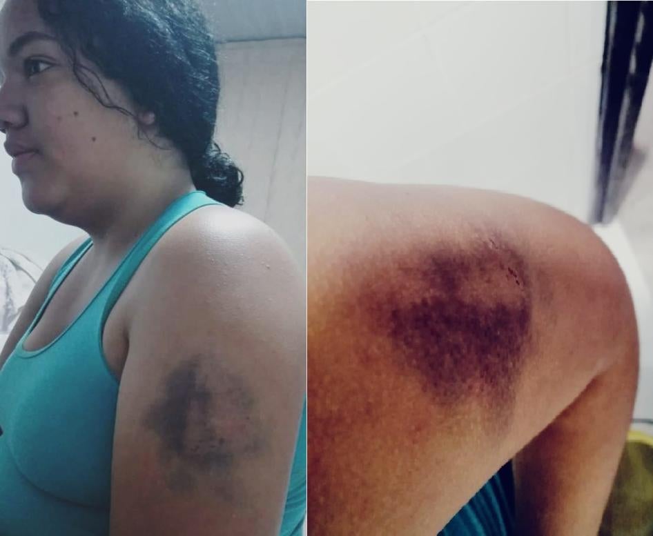 Natalia Gema Racero Cruz, at her home after being beaten by the police on November 22, 2019. 