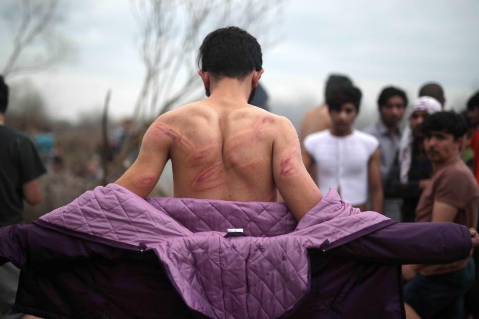 An asylum seeker in northern Turkey at the Greek border on March 6 shows injuries he says Greek security forces inflicted after he had crossed the Evros River into Greece. Photo by Turkish Radio and Television Corporation/Handout/Anadolu Agency.