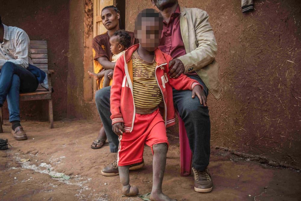 Un garçonnet de 6 ans, né à proximité de la mine d’or de Lega Dembi, dans la région éthiopienne de l’Oromia, n’a pas d’os dans le pied droit et seulement trois orteils au pied gauche.  © 2020 Tom Gardner