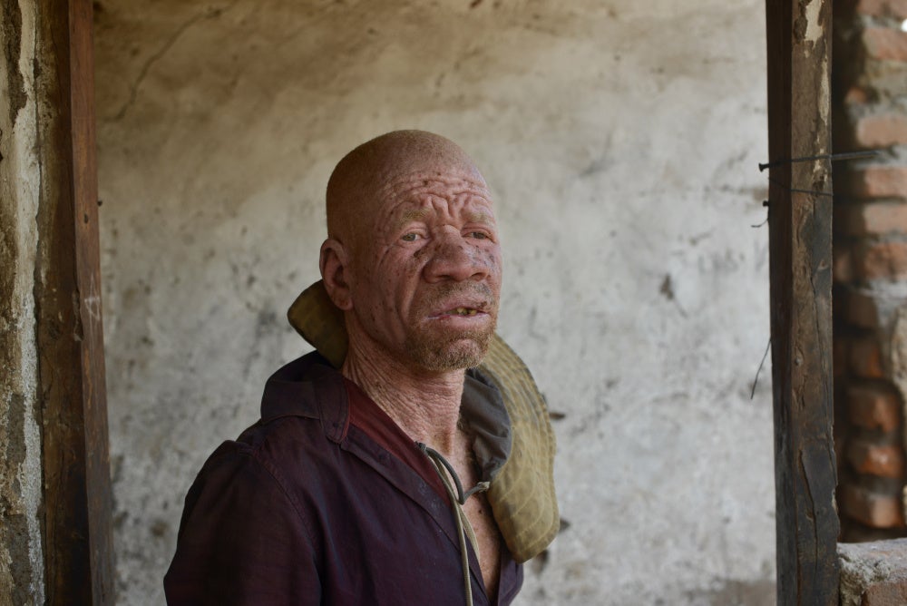 David Issa, un Malawien atteint d’albinisme âgé de 50 ans, habitant du district de Mangochi. 