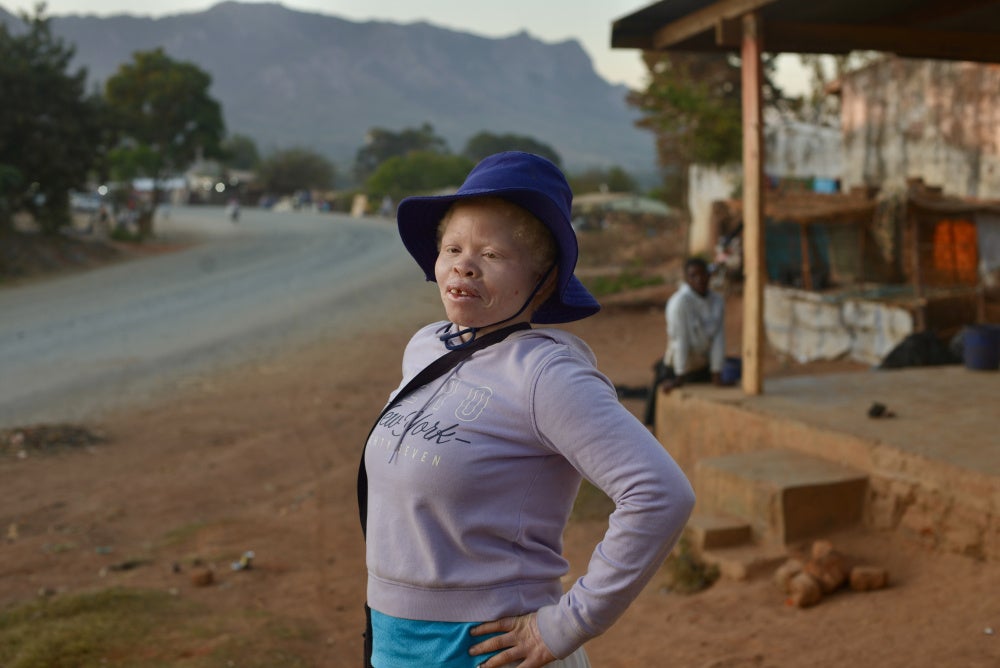 Mumderanji S., 25, from Dedza said that women with albinism faced a lot of discrimination,