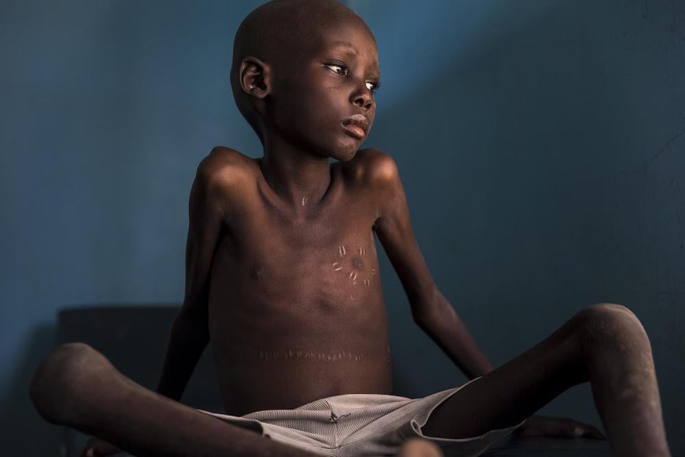 Un jeune garçon dans une clinique du comté de Turkana, au Kenya.
