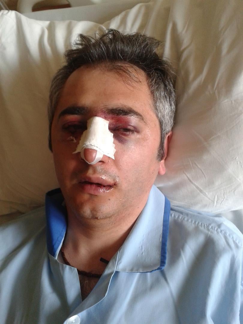 At a peaceful protest on July 29, 2016 in the Erebuni district of Yerevan, police forcibly detained and kicked Marat Yavromyan in the face, breaking his nose.