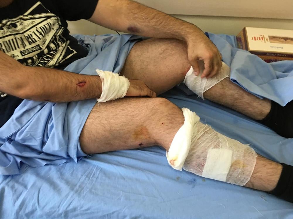 Robert Ananyan, a cameraman for A1+ information agency, shows lacerations he sustained on his arm and legs from exploding stun grenades used by police to violently disperse peaceful protestors in the Erebuni district of Yerevan on July 29, 2016. 