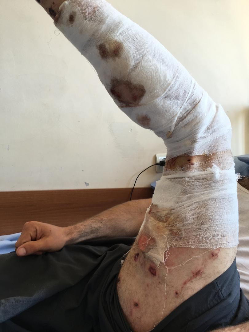 Suren (not his real name) received 30 lacerations as well as first and second degree burns covering both of his legs as the result of an exploding stun grenade fired by police into the middle of peacefully gathered crowds in the Erebuni district of Yereva
