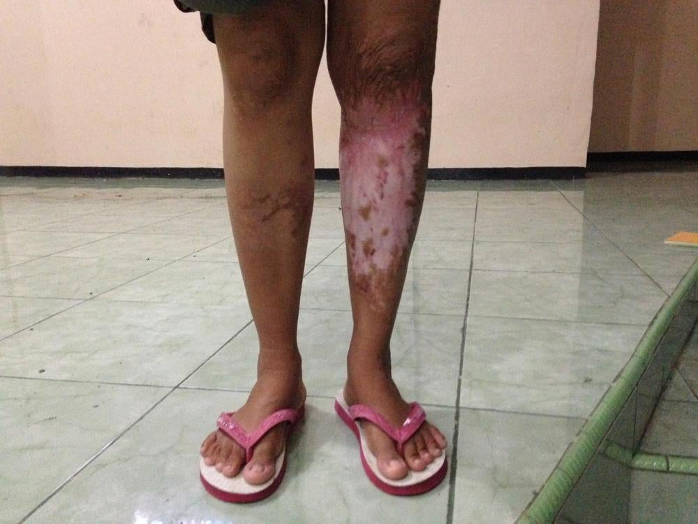 Seorang perempuan dengan disabilitas psikososial tinggal di PantiLaras Dharma Guna, lembaga layanan sosial di Bengkulu, Sumatra,menunjukkan bekas luka bakar yang dia dapat saat dia tak bisakabur dari api di rumahnya sebab orang tuanya mengikatnya padabalo
