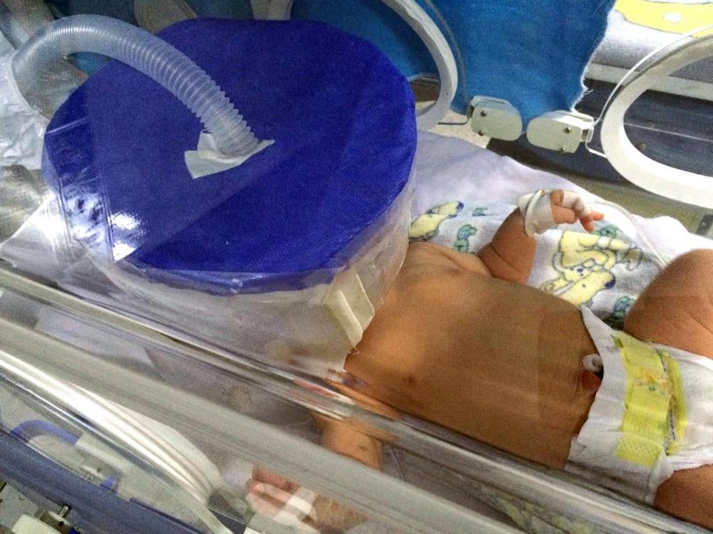 A baby breathes through an improvised oxyhood at the Neonatal Intensive Care Unit of San Cristobal Central Hospital in Táchira State, where such basic supplies are lacking, August 2016. 