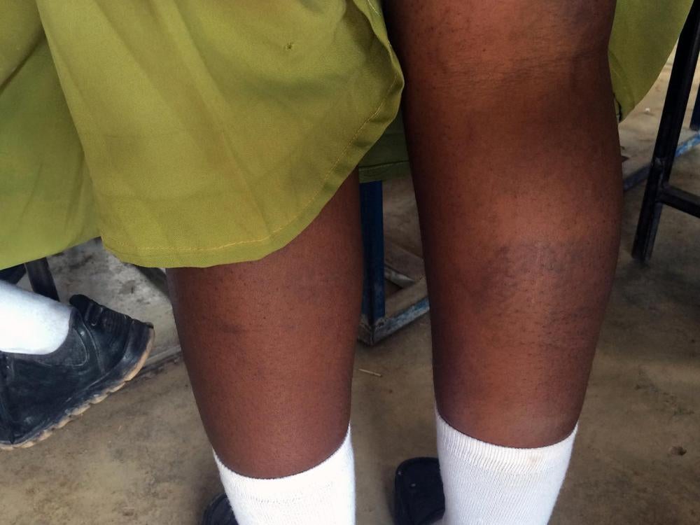 A girl shows the marks she sustained on her legs from regular caning by teachers in her school. She told Human Rights Watch: “We have marks in the legs, they hit our hands, they hit us on the head.”