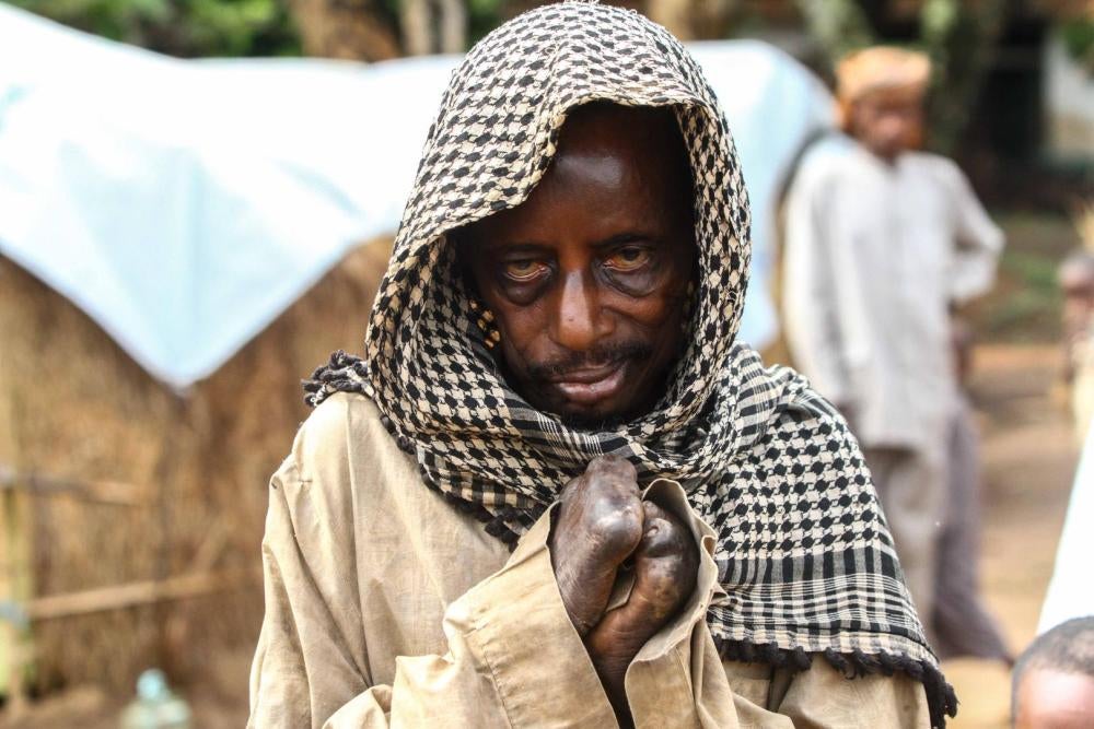 « Asaf », un Peul de 40 ans, au camp de l’Évêché à Bambari en République centrafricaine. Il a perdu ses doigts à cause d'une maladie quand il était enfant. Il dit avoir  fui sa maison en 2014 alors que les combats se rapprochaient. « Ils ont fini par me r
