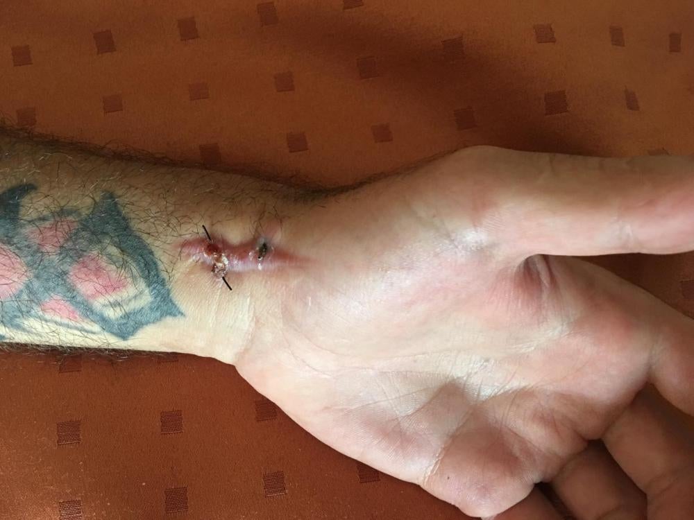 A local man on Papua New Guinea’s Manus Island slashed Masoud’s (not his real name) wrist with a knife in July 2017. Masoud has been held in Papua New Guinea for four years under Australia’s offshore processing policy. 
