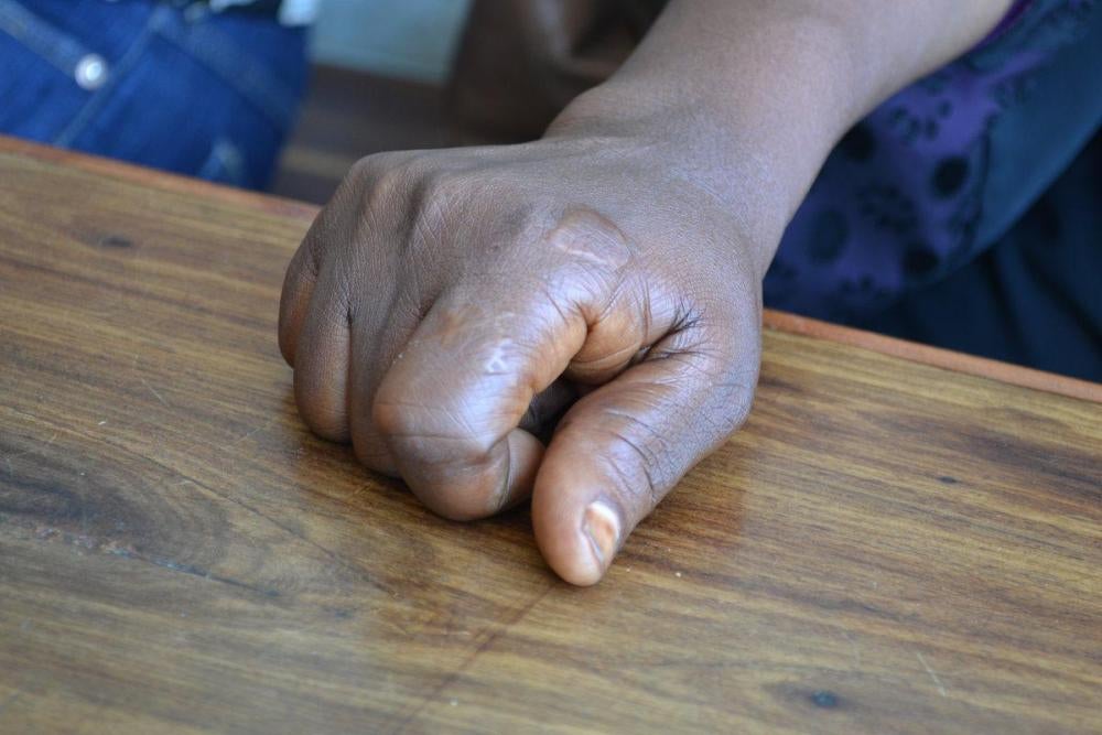 Rehema M., une femme tanzanienne âgée de 30 ans et photographiée à Dar es Salaam, montre sa main, brûlée lors de l’explosion d’un thermos qu’elle était en train de nettoyer alors qu’elle travaillait en tant qu’employée domestique à Oman. 