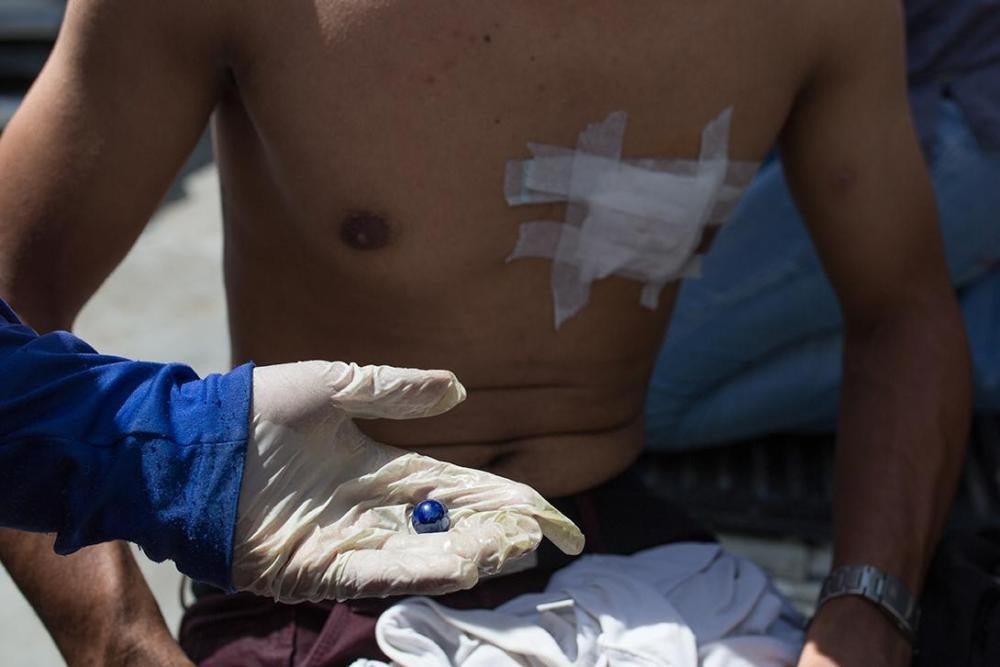 Un voluntario de primeros auxilios de la Universidad Central de Venezuela, que forma parte de una organización conocida como Cruz Verde, muestra una canica (metra) extraída del pecho de un manifestante alcanzado por un disparo efectuado por policías