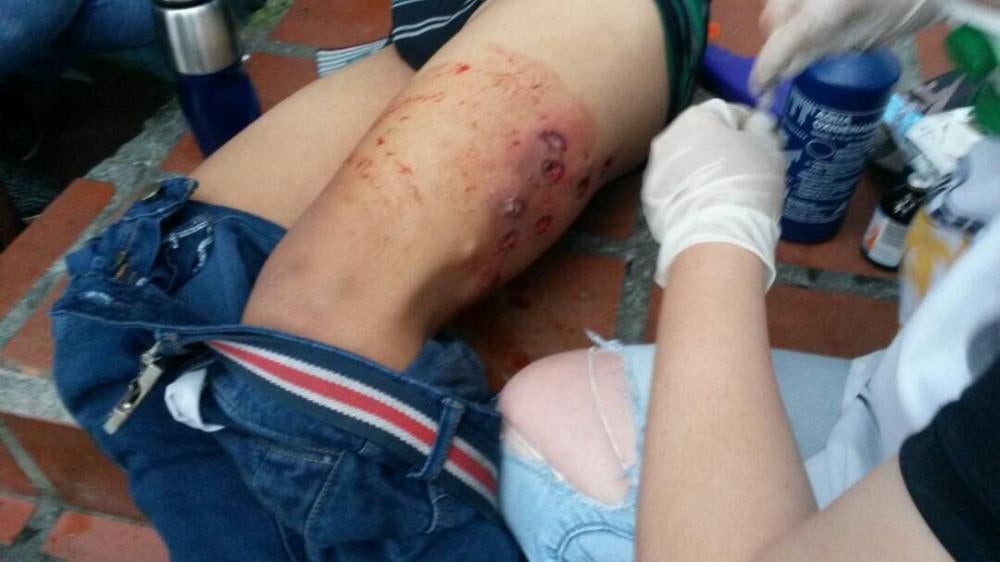 Bullet wounds on a man's leg