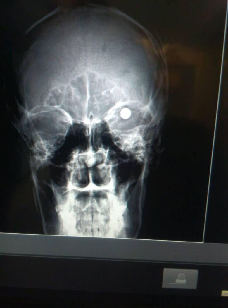 Radiografía de paciente herido por un perdigón que le perforó el ojo durante una manifestación contra el gobierno en Mérida, mayo de 2017.