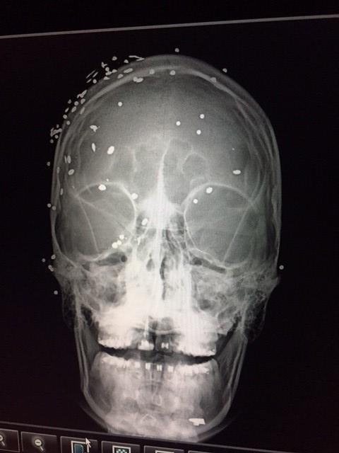 X-ray of patient injured during an anti-government demonstration in Caracas shows many pellet shots to the face and head.