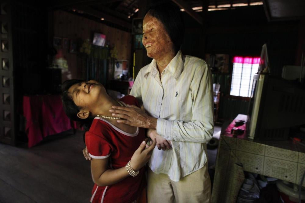 Cheav Chenda, une femme cambodgienne qui a perdu la vue à la suite d’une attaque à l'acide commise le 5 février 2008, photographiée à Kampong Cham avec sa fille un peu plus de deux ans après cette attaque le 30 juillet 2010.